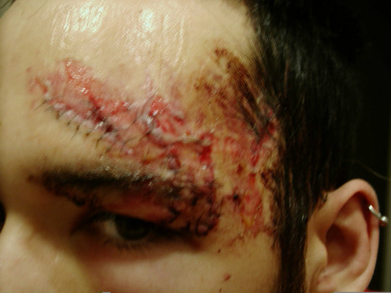 40600063.jpg My face..... 46 stiches later
