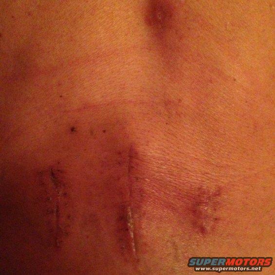 img_5193.jpg 5 1/2 weeks post surgery