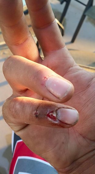 Hand with two injured fingers, one with a cut and dried blood