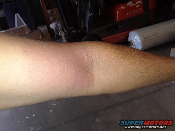 Arm with a distinct sunburn line, showing a lighter area transitioning to a darker, reddened area