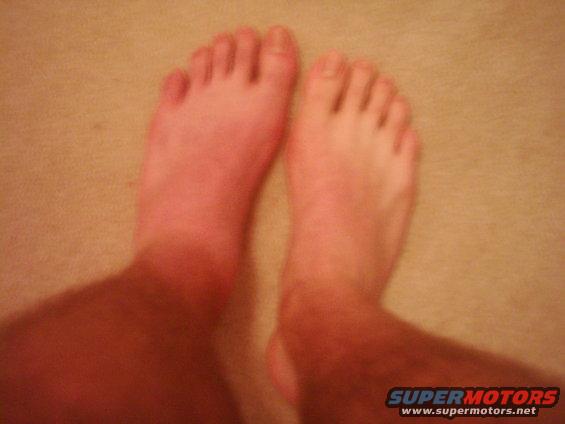 Two bare feet on a carpeted surface, one foot appears redder than the other