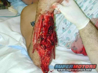 lateral20view20of20wound20web.jpg