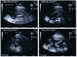 1981 Ford Bronco - its a boy