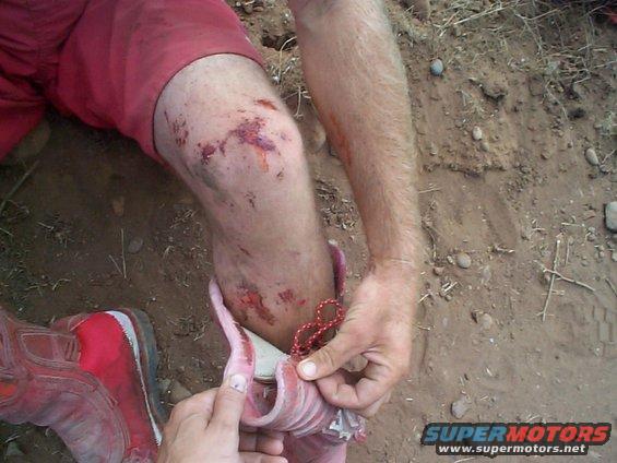 Injured leg with scraped knee and bloody abrasions, being tended to with a pink shoe