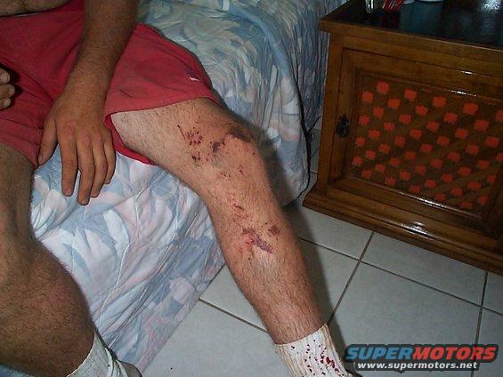 Person's leg with scrapes and bruises, wearing red shorts and white socks with bloodstains