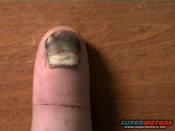 my smashed finger with nail