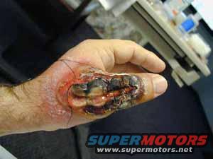Hand with severe injury, possibly a burn or deep cut, with exposed tissue and stitches. Text overlay reads SUPERMOTORS