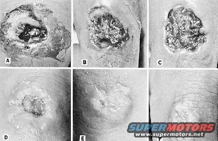 Six medical diagrams labeled A through F showing different stages of skin lesions