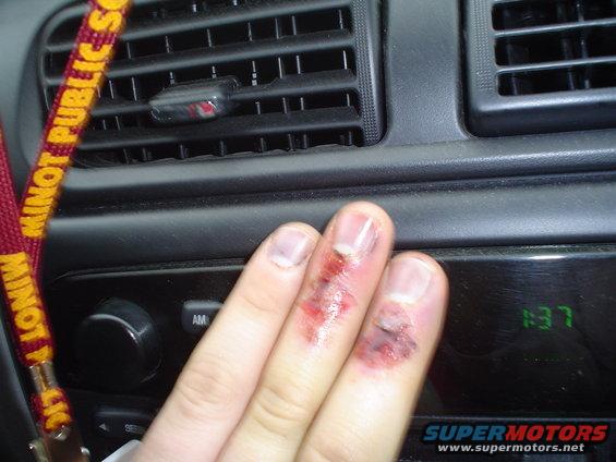Injured fingers resting on car dashboard near air vents and clock displaying 1:37