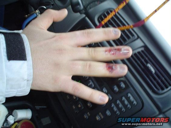 Hand with cuts on fingers resting on car controls