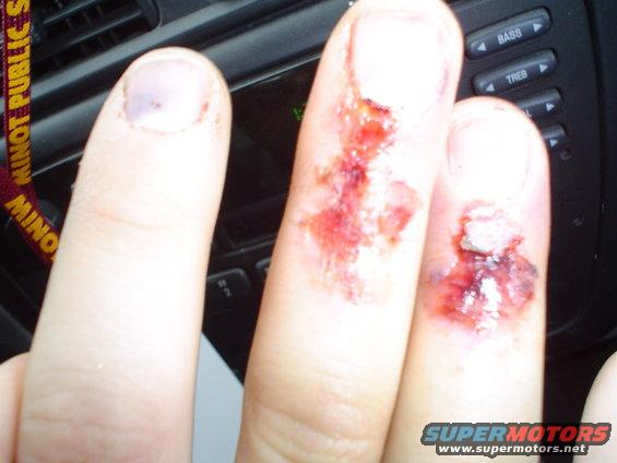 Injured fingers with cuts and bruises in front of car dashboard controls