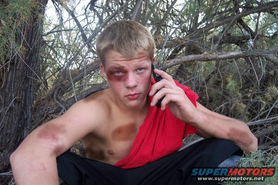 Man with black eye and bruises on arms talking on phone in woods