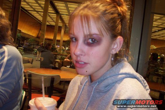 Young woman with a black eye holding a drink
