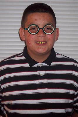 Boy with round glasses and acne on his face and neck