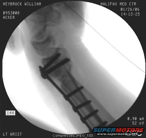 wrist-xray2.jpg 