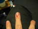 1997 Ford Crown Victoria - A close-up view of an injured finger with visible blood and damage to the nail bed.