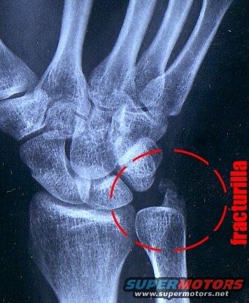 Wrist x-ray showing a fracture, marked with red circles and text 'fracturilla'