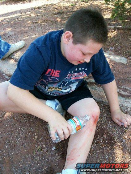 Christian's injury while hiking
