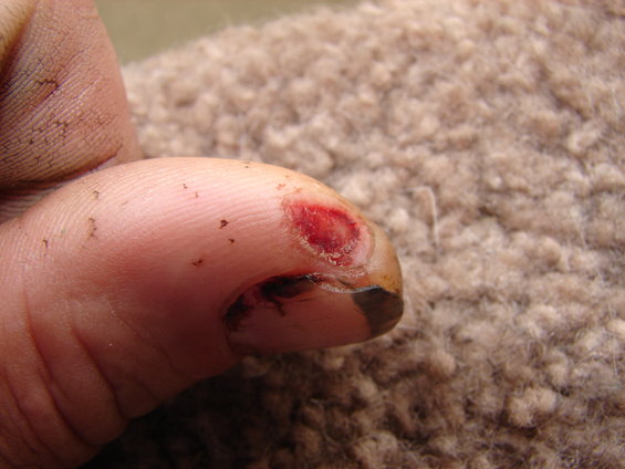 Close-up of an injured thumb with a cut on the nail bed and dirt under the fingernail
