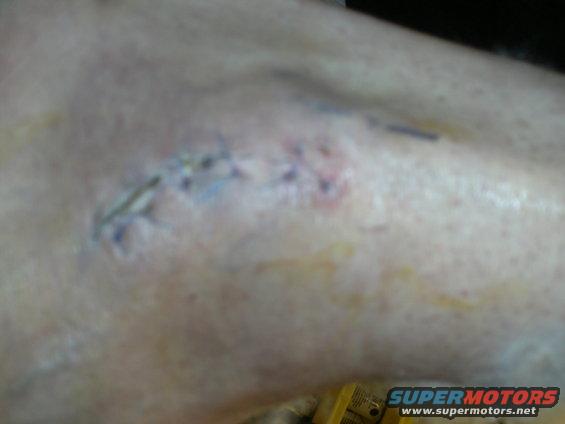 Stitched wound with blue sutures and bruising