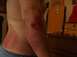 2002 Ford Mustang - A person's arm and torso display a red, irritated skin condition, with a Kobe Bryant jersey hanging in the background.
