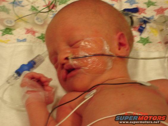 Premature infant with medical tubes and wires attached