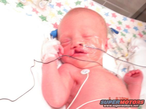 Premature infant with medical tubes and wires in an incubator