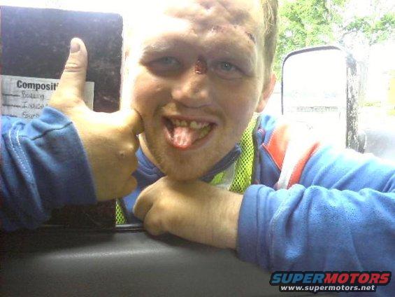 Man with facial injuries and tongue sticking out gives a thumbs up