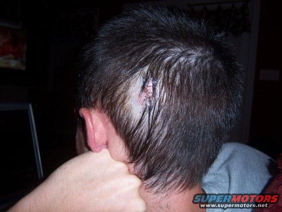 6-staples-later.jpg 