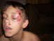 1992 Ford Bronco - A child appears to have sustained injuries to the face, including a swollen eye and cuts.
