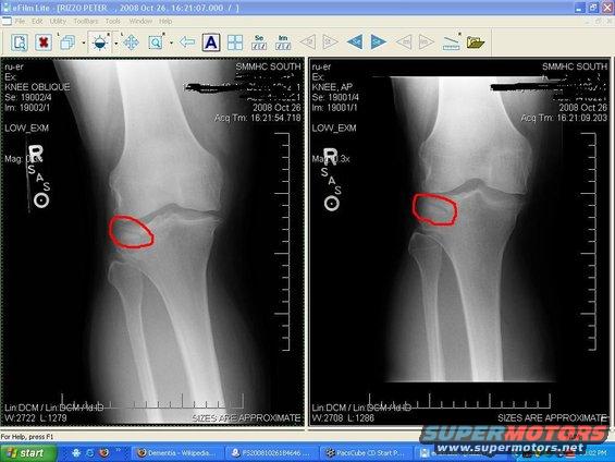 Medical x-ray of a knee with a red circle highlighting an area