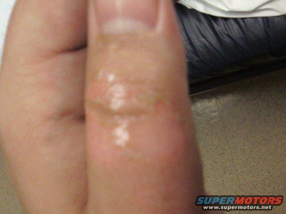 Close-up of a blister on a finger