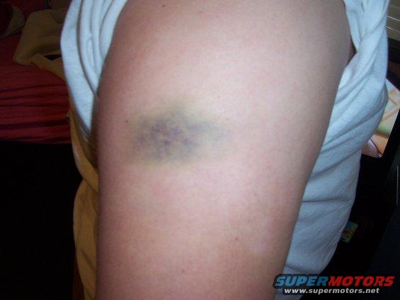 Bruise on a person's upper arm, with a white shirt visible