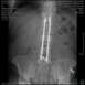 1978 Ford F-250 - This medical image displays a lumbar sacral spine with surgical hardware.