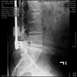 1978 Ford F-250 - This is a medical X-ray image, not a photograph of a vehicle.