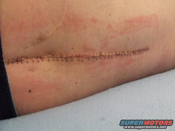 Close-up of a surgical incision closed with staples on skin with some redness