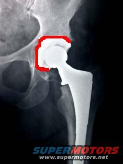 X-ray of a hip with a replacement implant