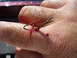 1993 Tracker Tournament - A fishing hook is embedded in a person's hand, causing bleeding.