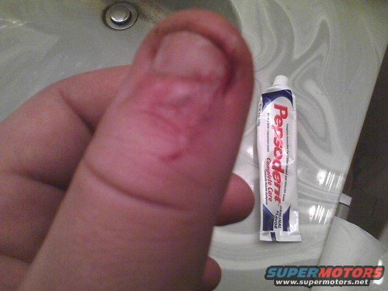 Thumb with cuts next to a tube of Pepsodent toothpaste on a sink