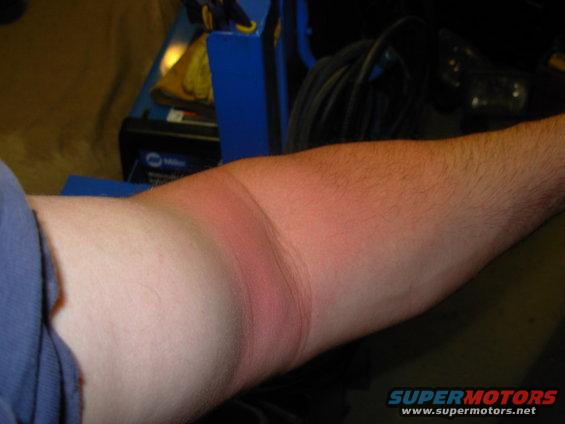 9312lbow.jpg Ouch - need T-shirts with SLIGHTLY longer sleeves.