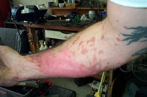 1995 Ford Bronco - Been hard to work lately with this on my arm. Fried turkey fell back in the pot after it was being pulled out.