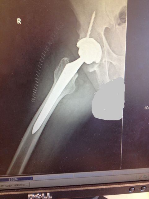 1975 Ford Ranchero - This is an X-ray showing a hip implant with a screw securing the acetabular component.