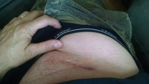 1985 Jeep CJ7 - A person's hand rests on their thigh, revealing a surgical scar on the skin. The person is wearing camouflage pants and black underwear.