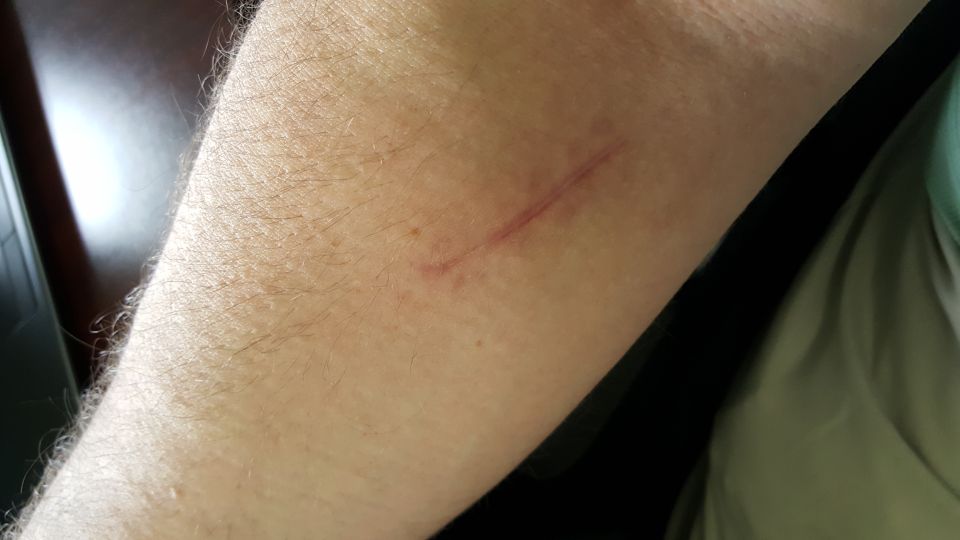 Close-up of an arm with a faded scar.