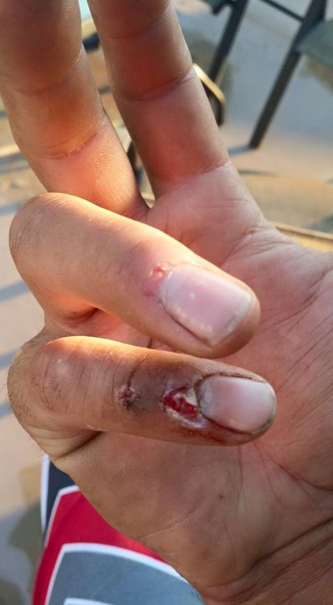 1984 Ford Bronco - A close-up view of a hand showing two fingers with injuries, one appearing to be a cut with dried blood.