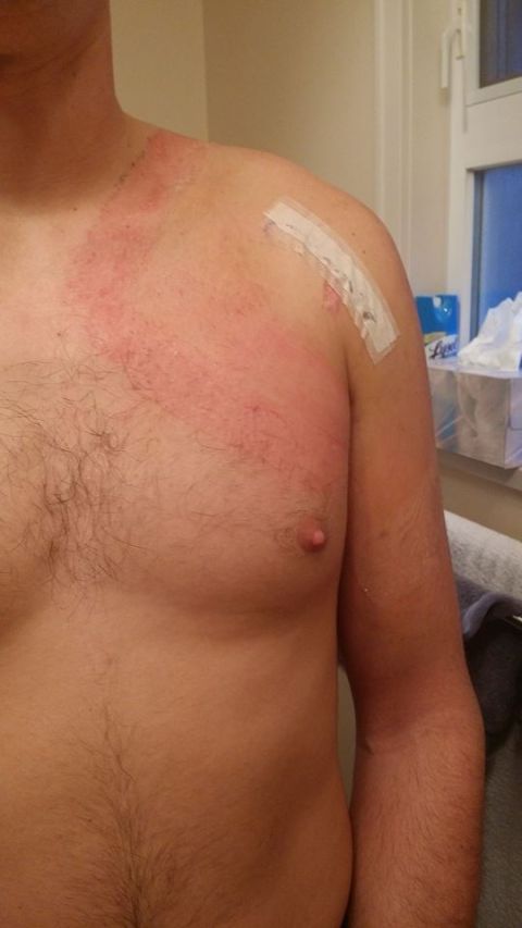1984 Ford Bronco - A person's upper torso displays a widespread red rash, with a bandage applied to their shoulder.