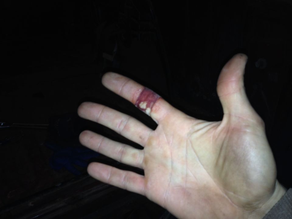 Photo of an open hand with a cut on one finger