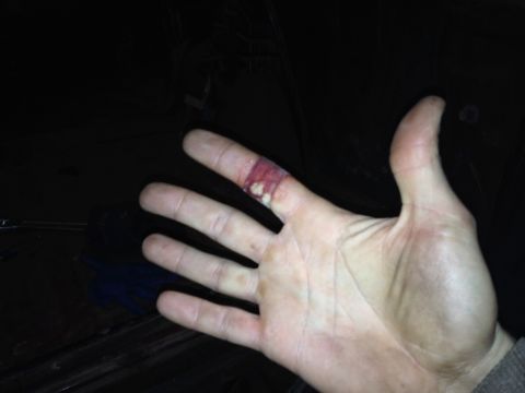 Photo of an open hand with a cut on one finger