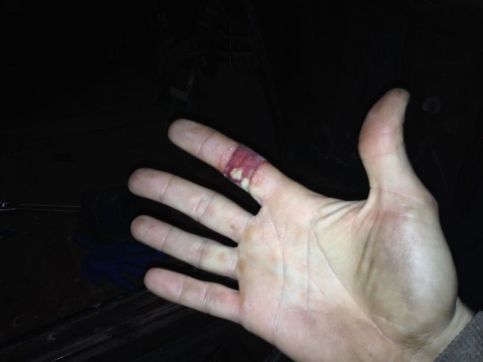 Photo of an open hand with a cut on one finger