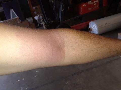 1994 Ford Bronco - A close-up view of an arm displaying a clear sunburn line, indicating sun exposure.